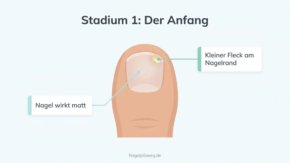 Illustration: Nagelpilz im Anfangsstadium mit Fleck am Nagelrand