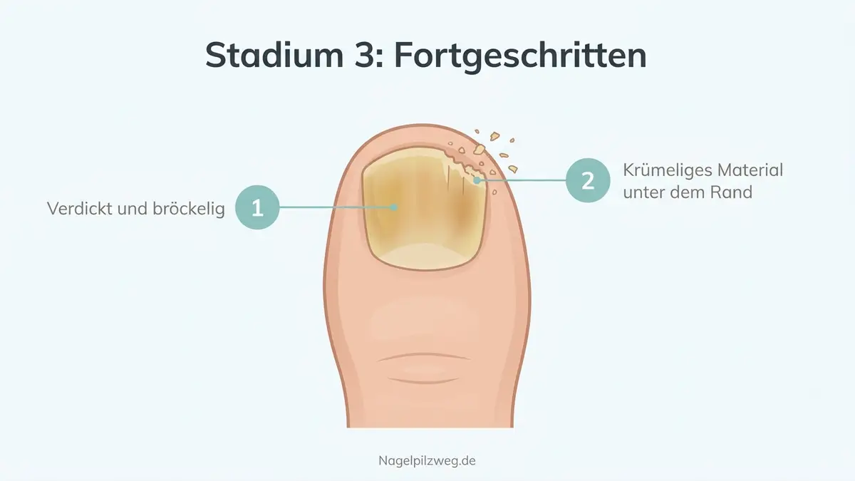 Illustration: fortgeschrittener Befall mit bröckelndem, verformtem Nagel